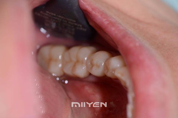 Bloc dentar din zirconiu multistrat UT