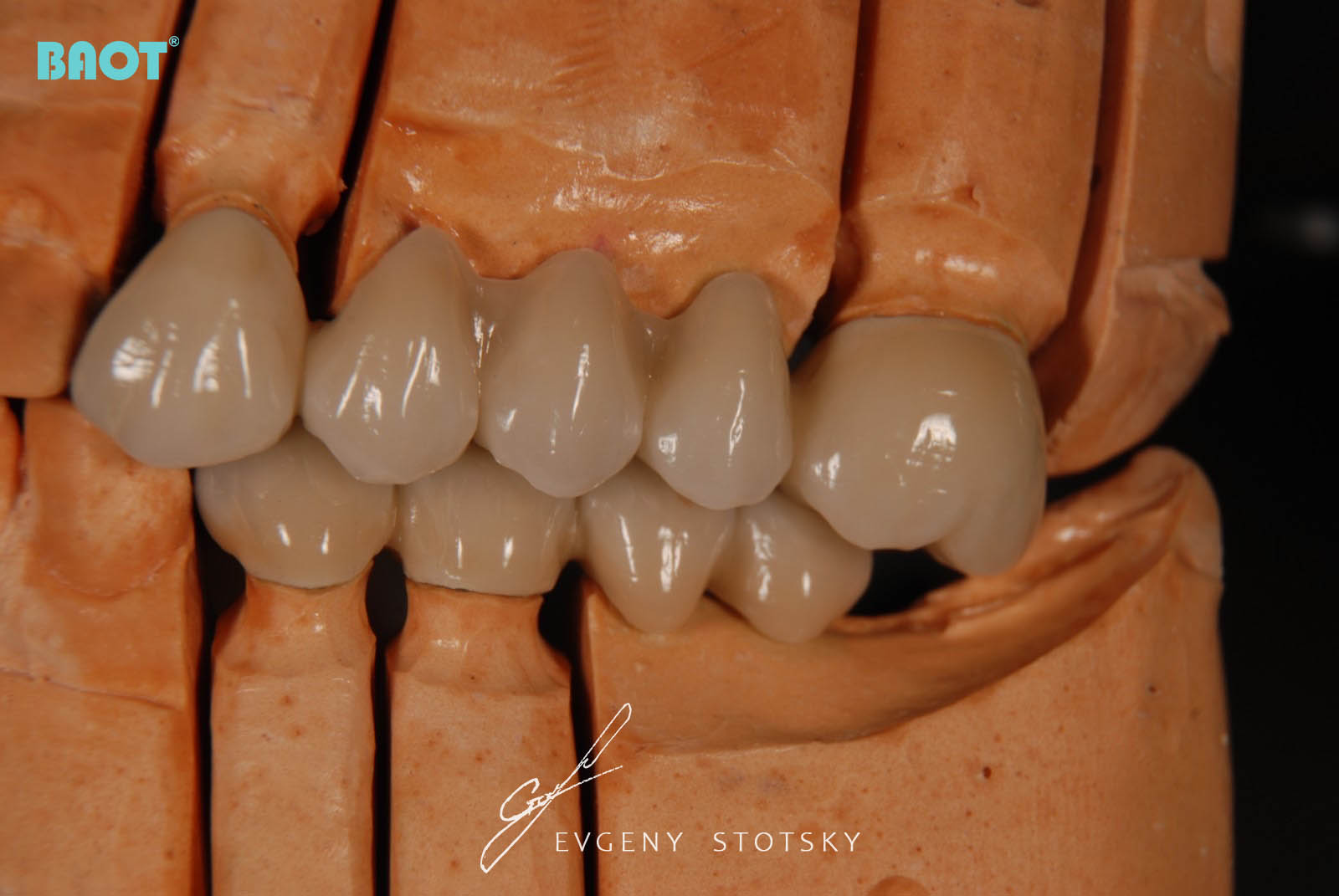 Utilizarea ceramicii pentru proteze dentare