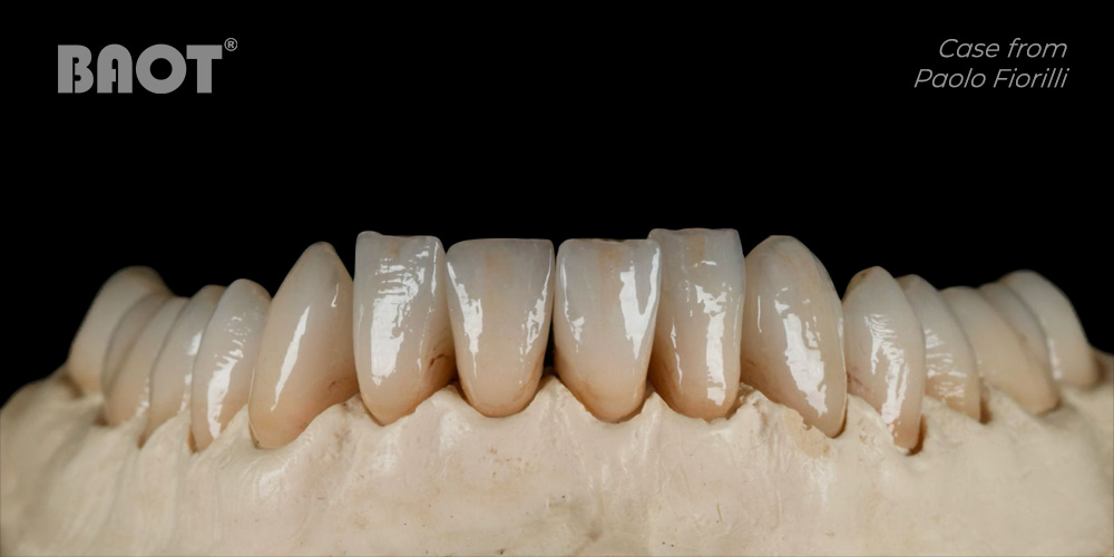 BAOT dental glaze for natural gloss for dental restorations BAOT dental glaze for natural gloss for dental restorations