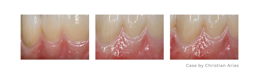 Zirconia Ceramic Restoration Dental Stain Glaze Paste Zirconia Ceramic Restoration Dental Stain Glaze Paste